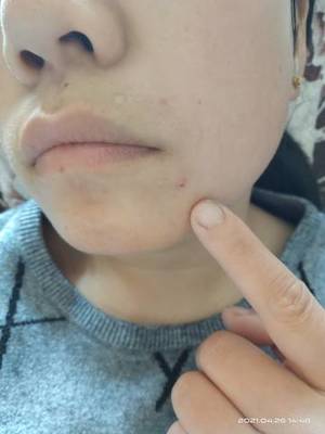 痘痘一摸就疼