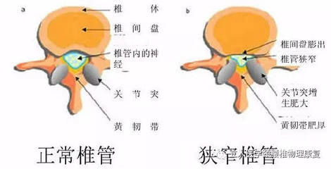 椎间盘膨突出怎么治疗