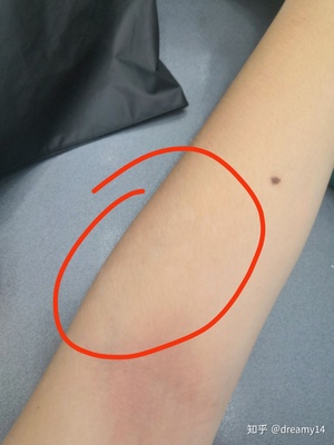 长痘痘和男友分手
