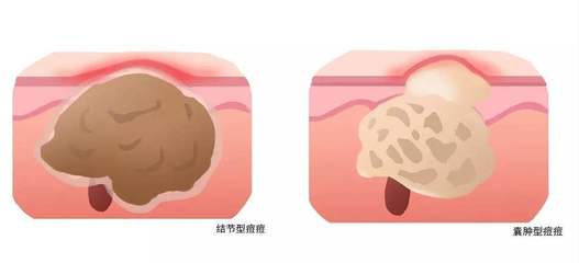 好多痘痘烦死了