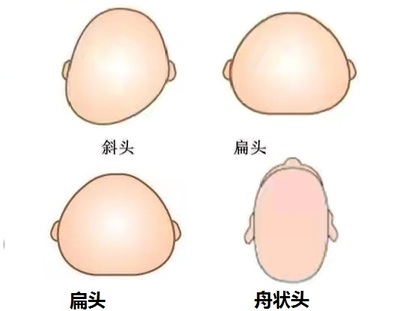 胎儿椭圆形头型图片