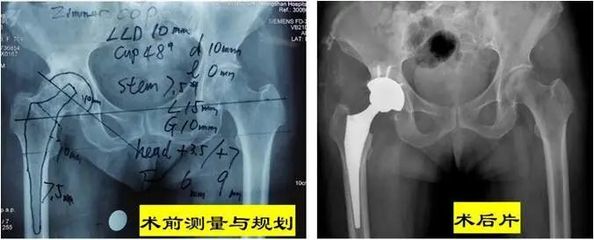 股骨头坏死检查需要多少钱