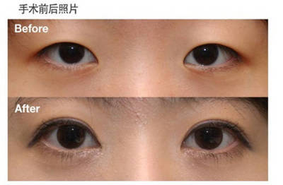 内眦开眼角