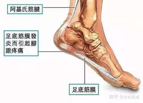 足底筋膜炎怎么治疗