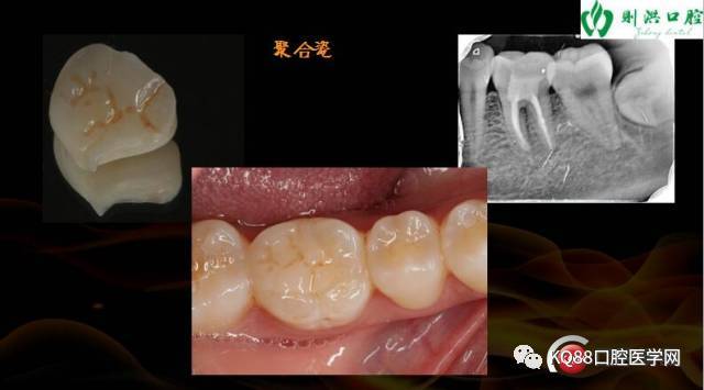 牙科rct是什么意思