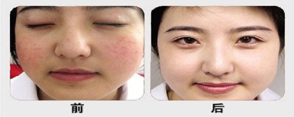 脸部红血丝怎么治