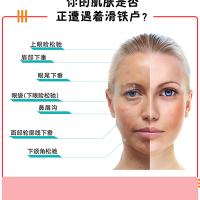 埋线提升脸
