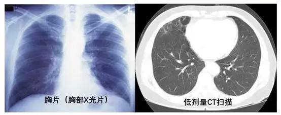 肺癌晚期怎么治疗