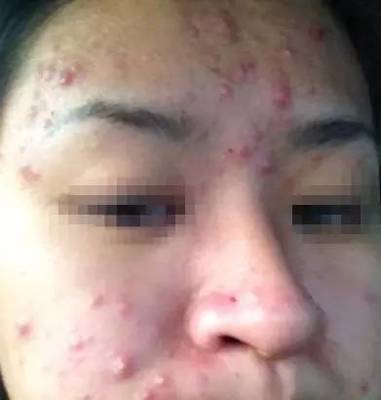 脸上用什么才能祛痘痘