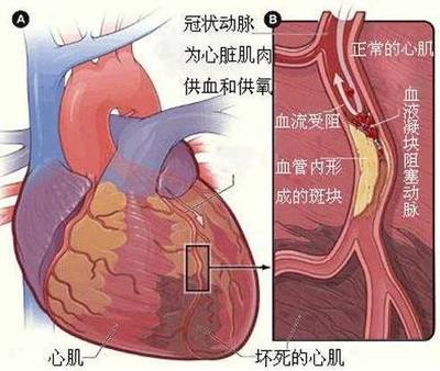 心机缺血是怎么回事