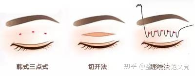 埋线双眼皮的好处