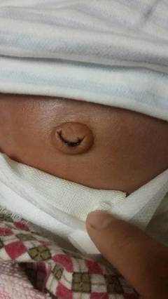 宝宝肚脐掉了还出血正常吗