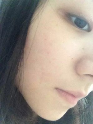 长痘痘用了补水面膜吗