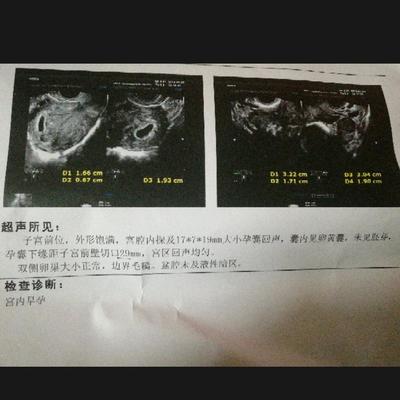 剖腹产两个月来月经正常吗