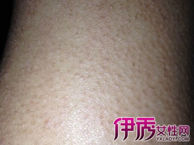 后背其小痘痘 很痒