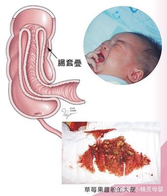 宝宝肠套叠症状