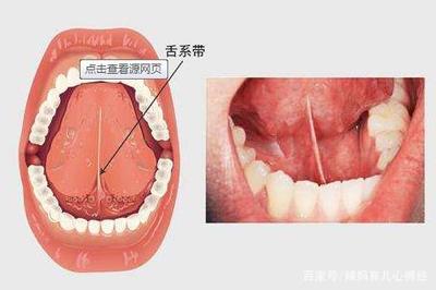 宝宝舌头短图片