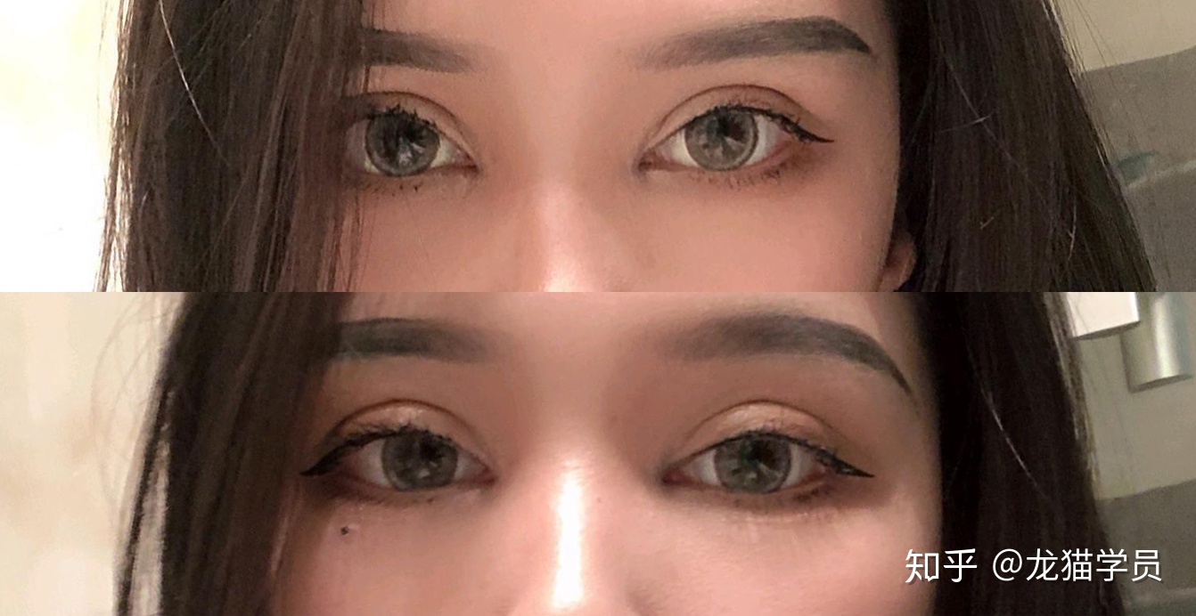 双眼皮成功案例