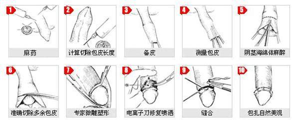 婴儿包皮粘连手术多少钱