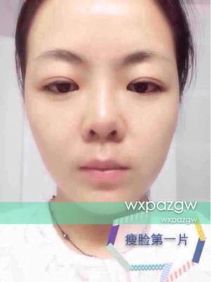 用什么可以瘦脸