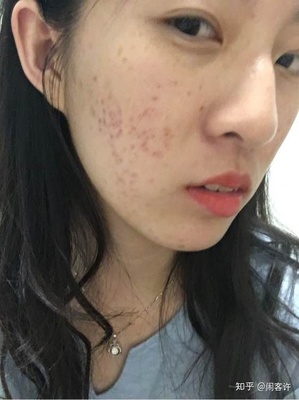 吃辣脸上长痘痘怎么办