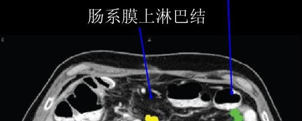 淋巴结钙化是怎么回事