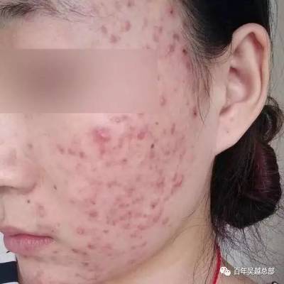 痘痘好了黑色