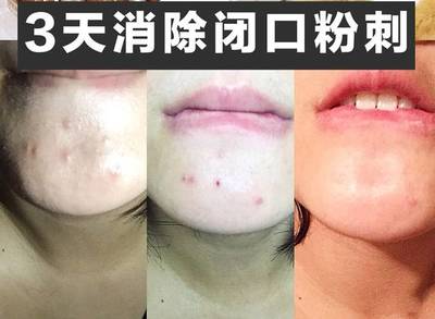 闭口痘痘和闭口粉刺怎么办