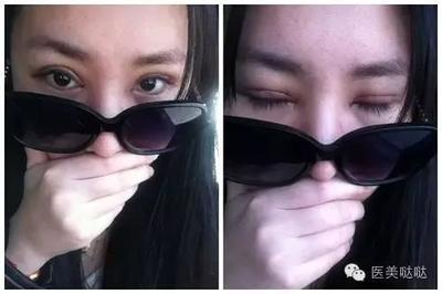 割了双眼皮能看手机吗