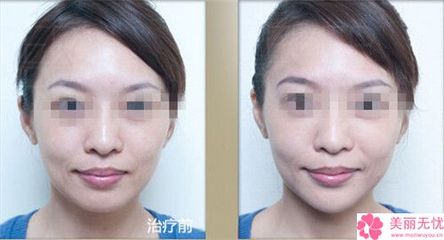 保妥适除皱效果怎样