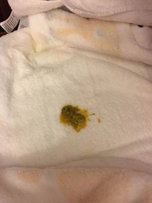 一岁宝宝拉黑色大便怎么回事