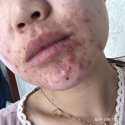 怎么去除囊肿型痘痘