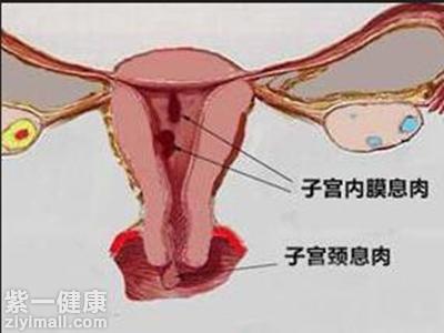 内膜息肉怎么治疗