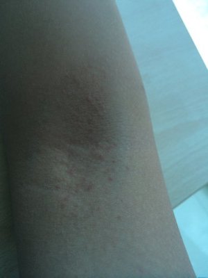 胳膊里有小疙瘩是怎么回事