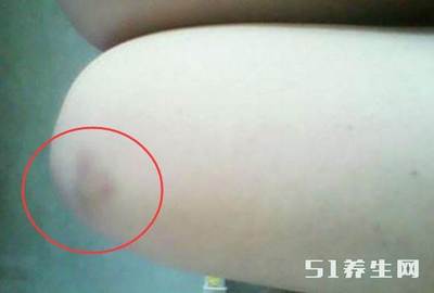 身体很容易淤青是怎么回事