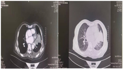 老人肺部积液怎么治疗