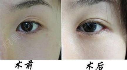 双眼皮埋线修复