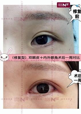 小儿眼睑下垂怎么治疗