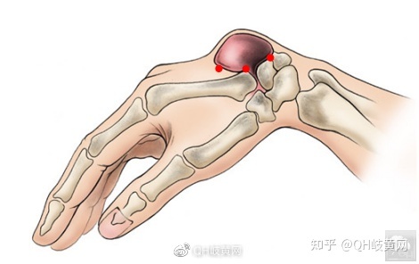 腱鞘囊肿是怎么引起的怎么治疗