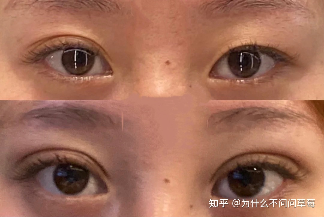 做双眼皮微创