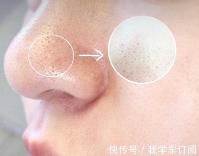鼻子上面长白色痘痘原因