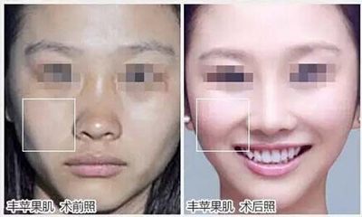 玻尿酸丰苹果肌效果