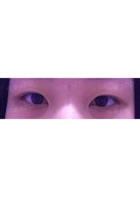单眼皮怎么整双眼皮