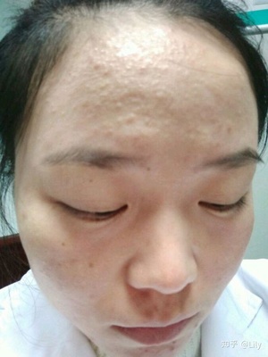 嘴周一直长痘痘