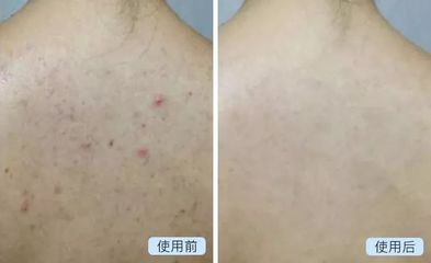 背上突然长了一背痘痘