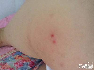 屁股两边疼是怎么回事