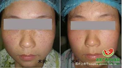 去斑美白要多少钱