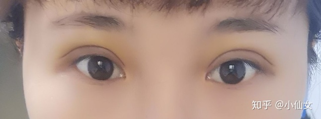 右眼皮肿是怎么回事