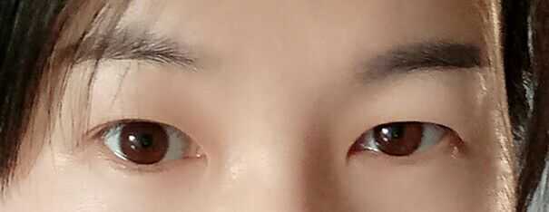 右眼皮肿是怎么回事