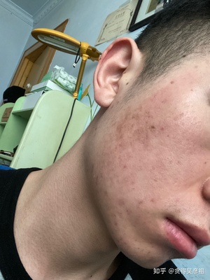 痘痘爆不出来吗